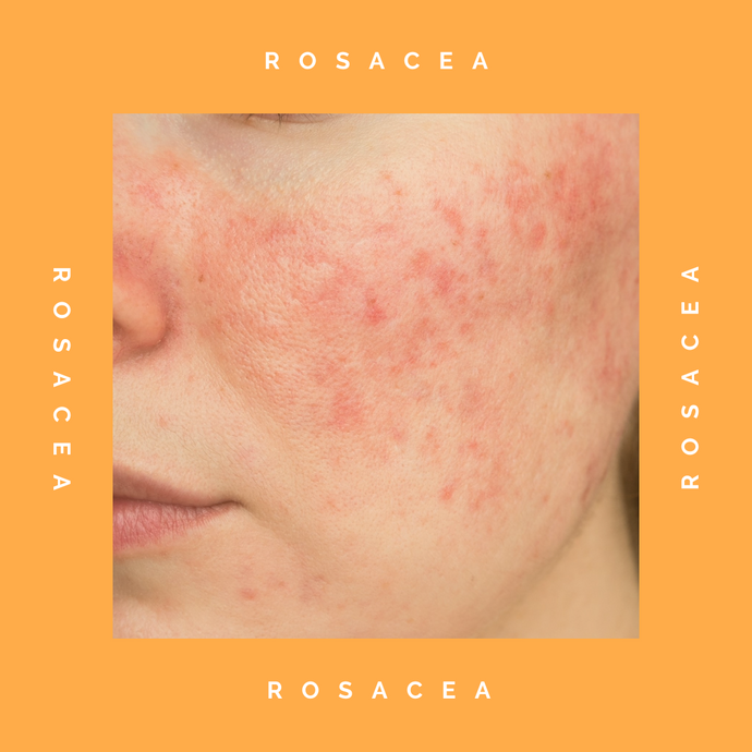 Decoding Rosacea: Insights, Triggers, And Holistic Management Strategies